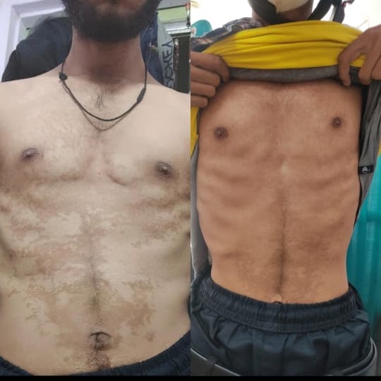 Before and after — skin treatment result