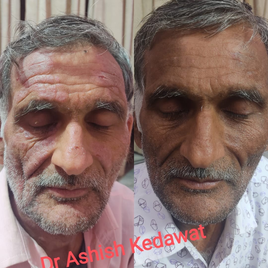 Before and after — eczema treatment