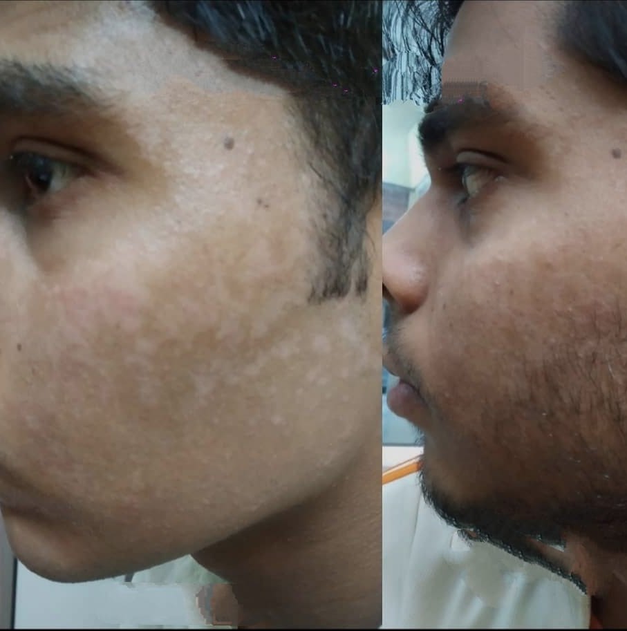 Before and after — psoriasis treatment
