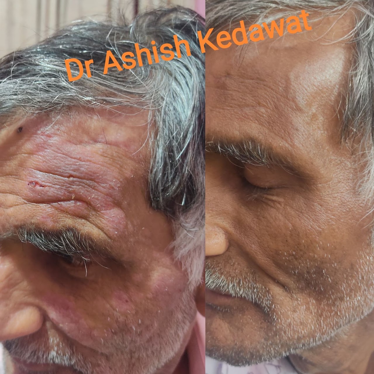 Before and after — allergy treatment