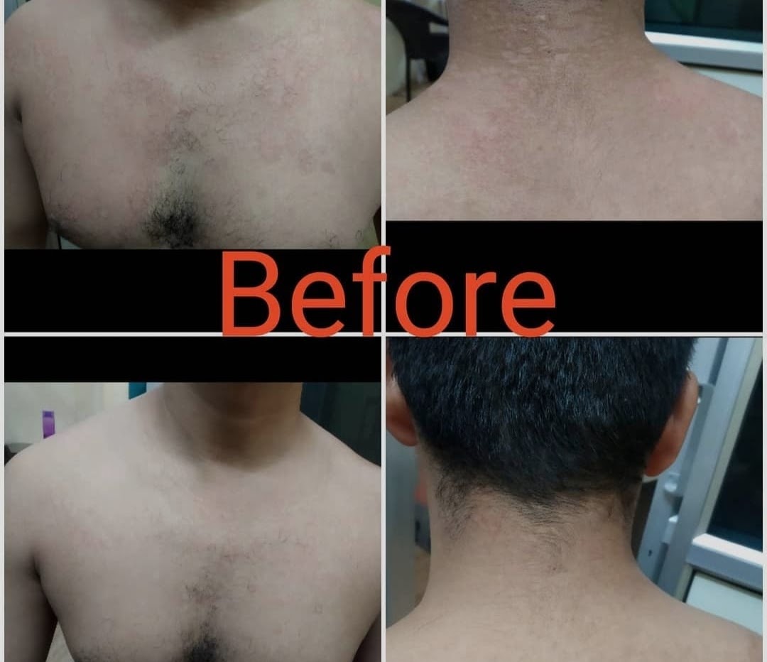 After treatment — urticaria result