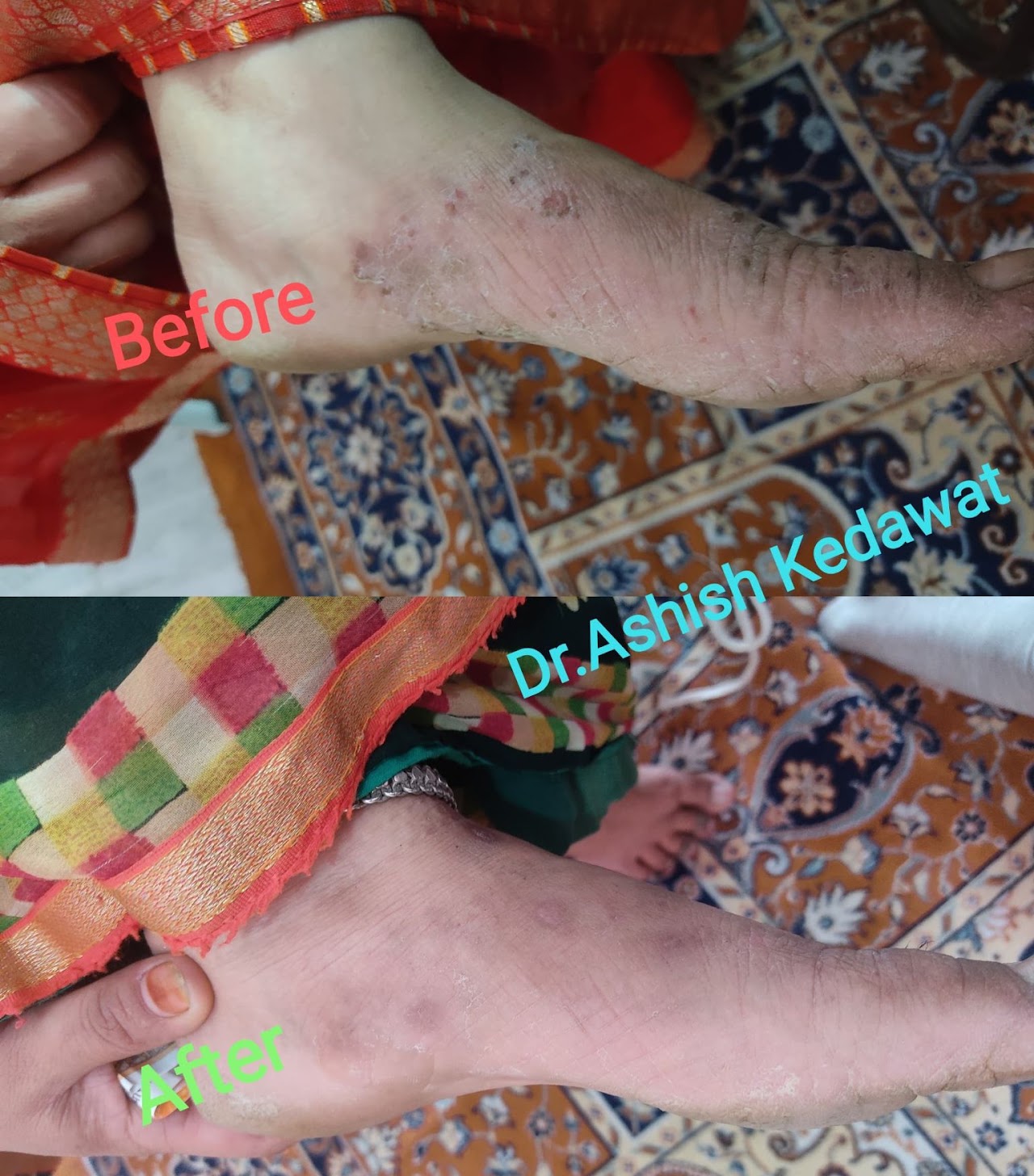After treatment — acne result